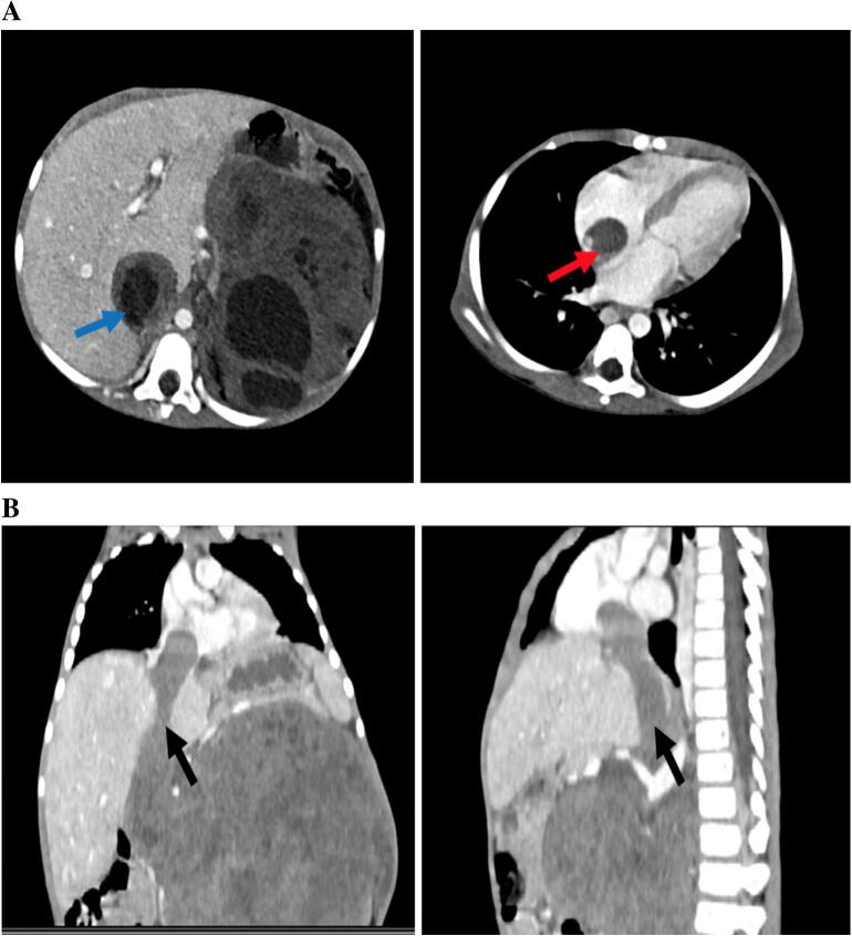 Surgical and diagnostic management challenges of giant Wilms tumor with intracardial and IVC thrombus extension in a 3-year-old: A rare case from a resource-limited facility involving global and local pediatric surgical teams.