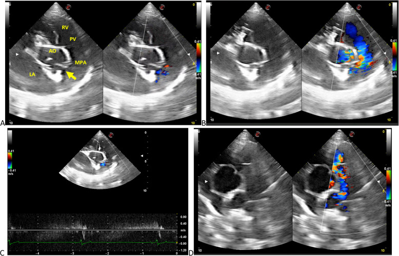 Case report of an incidental left coronary artery to main pulmonary artery fistula in a dog.