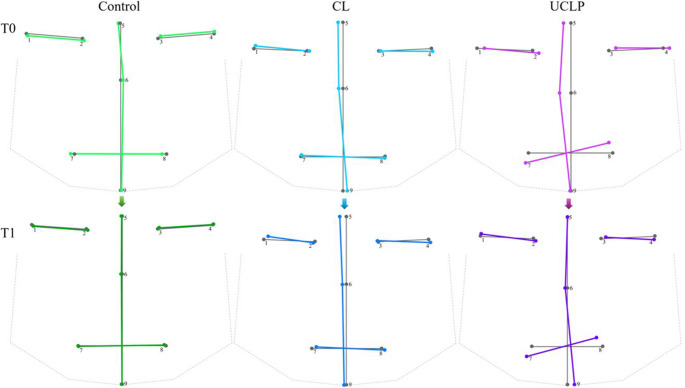 From infancy to toddlerhood: A 3D analysis of facial asymmetry in children with and without orofacial clefts.
