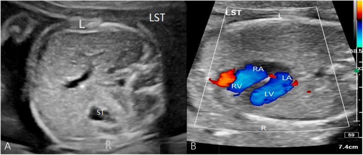 The Ultrasound and Genetic Characteristics of Fetuses With Laterality Defects-A Prenatal Cohort in Asian Population.