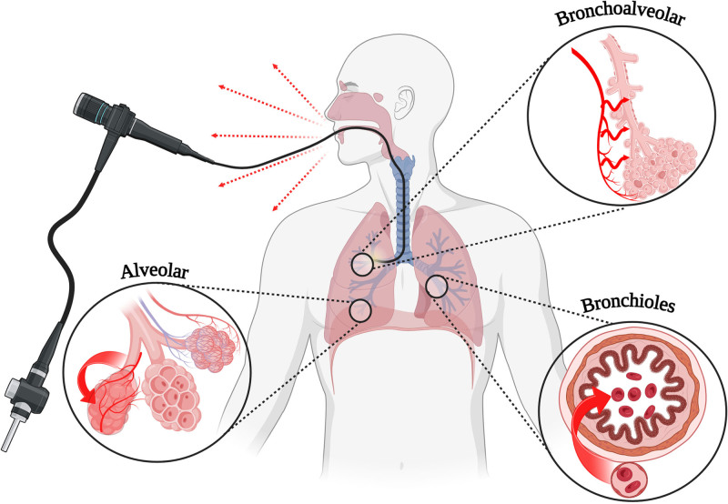 The Novel Application of Surgiflo and Successful Hemostasis of Refractory Intrapulmonary Hemorrhage in Extracorporeal Membrane Oxygenation.