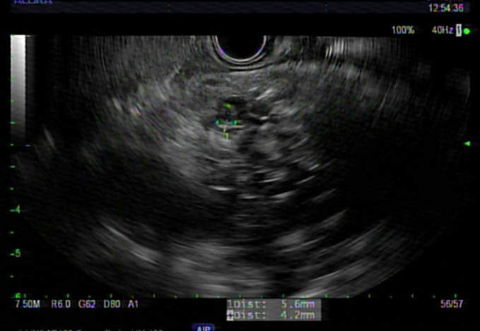A Case Report of Acinar Cell Cystadenoma with Pancreatic Intraepithelial Neoplasia: Is It Always Benign?