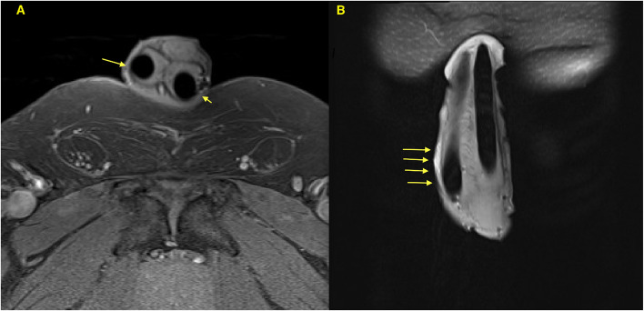 Management of tunica albuginea disruption secondary to malleable penile implant fracture: insights into etiology and surgical approach.