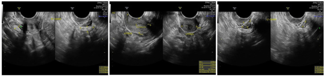 Bilateral Streak Ovaries in a Patient with Isochromosome Xq: A Case Report of a Turner Syndrome Variant.