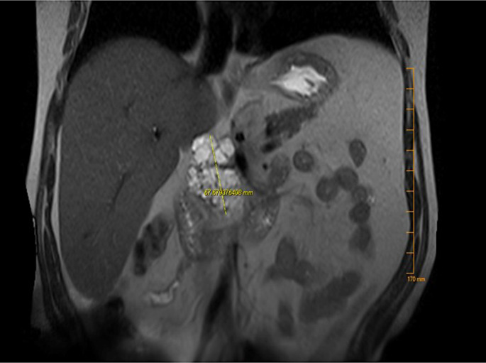 A Case Report of Acinar Cell Cystadenoma with Pancreatic Intraepithelial Neoplasia: Is It Always Benign?