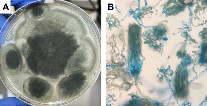 A Case of Bronchoscopic Removal of Aspergilloma in Patients With Non-Surgical Indications.