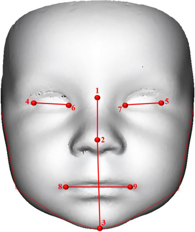 From infancy to toddlerhood: A 3D analysis of facial asymmetry in children with and without orofacial clefts.