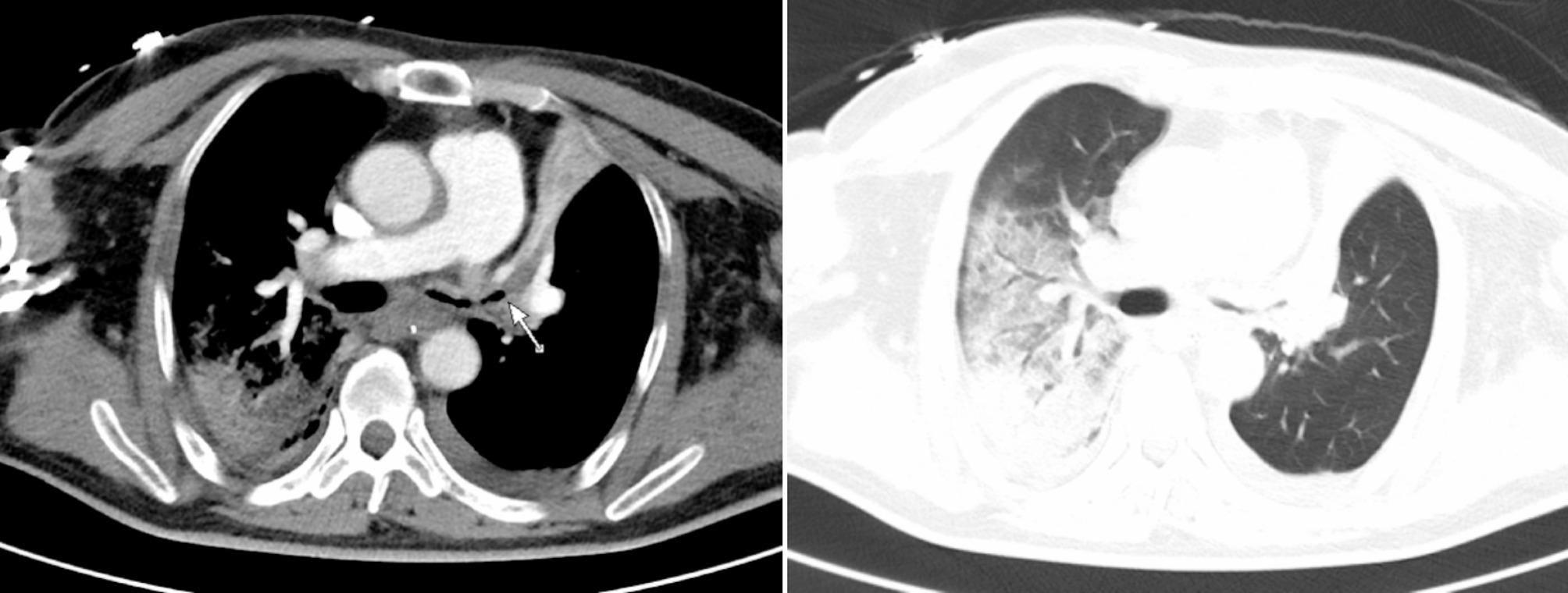 Venovenous extracorporeal membrane oxygenation catheter related superior vena cava syndrome without pre-existing stenosis in an adult patient: a case report.