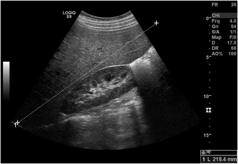 Mauriac syndrome: a rare complication in patients with type 1 diabetes mellitus.