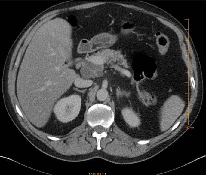 A Case Report of Acinar Cell Cystadenoma with Pancreatic Intraepithelial Neoplasia: Is It Always Benign?