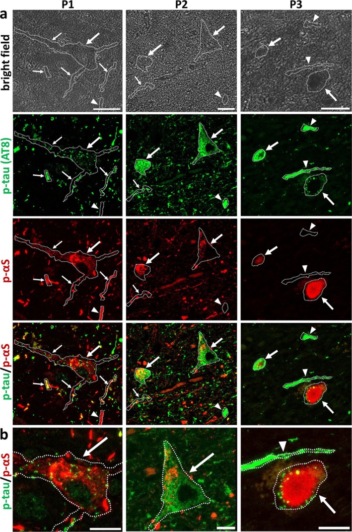 Protein Coaggregation in Caribbean Atypical Parkinsonism: The Contribution of Annonacin.