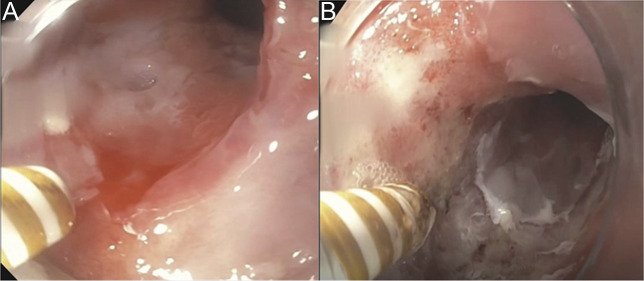Radiation-Associated Vascular Ectasias in the Esophagus: A Rare Cause of Recurrent Upper Gastrointestinal Bleeding.