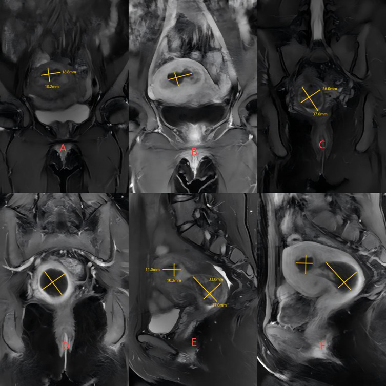 Hysteroscopic Myomectomy for Type 2 Submucosal Myoma Pretreated by HIFU and Mifepristone Treatment: A Case Report and Literature Review.