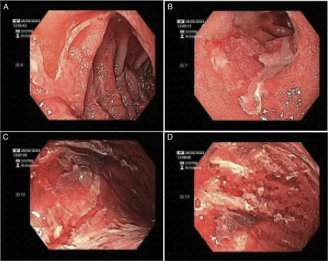 Nivolumab-Induced Refractory Hemorrhagic Gastritis and Duodenitis Requiring Multimodal Biologic Therapy.