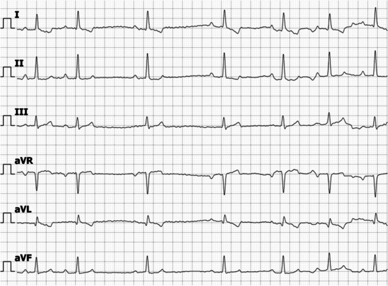Case report of an incidental left coronary artery to main pulmonary artery fistula in a dog.