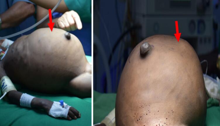 Surgical and diagnostic management challenges of giant Wilms tumor with intracardial and IVC thrombus extension in a 3-year-old: A rare case from a resource-limited facility involving global and local pediatric surgical teams.
