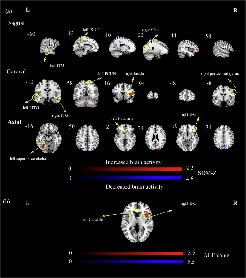 Structural and functional brain abnormal alteration in patients with type 2 diabetes mellitus: A coordinate-based meta-analysis.