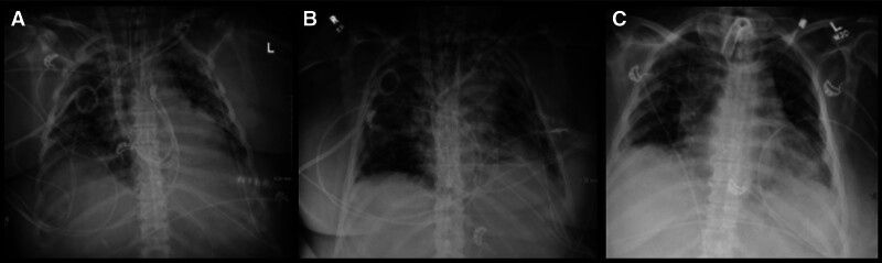 The Novel Application of Surgiflo and Successful Hemostasis of Refractory Intrapulmonary Hemorrhage in Extracorporeal Membrane Oxygenation.