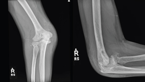 Elbow Interpositional Arthroplasty using an Achilles Tendon Allograft: A Case Report.
