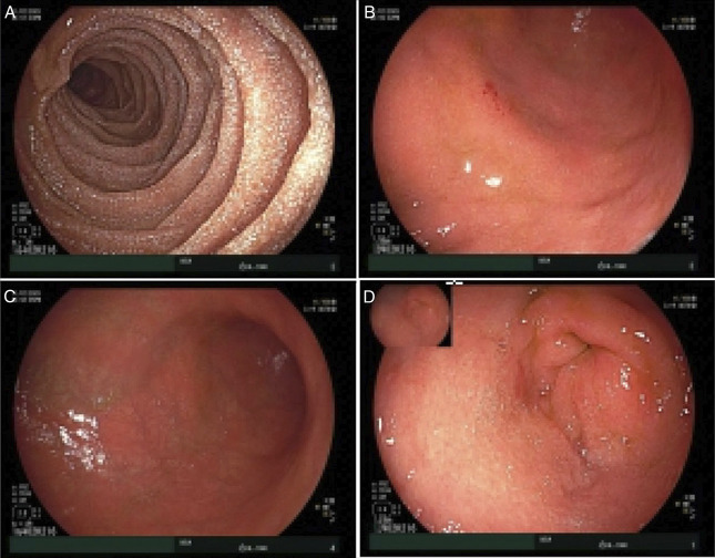 Nivolumab-Induced Refractory Hemorrhagic Gastritis and Duodenitis Requiring Multimodal Biologic Therapy.
