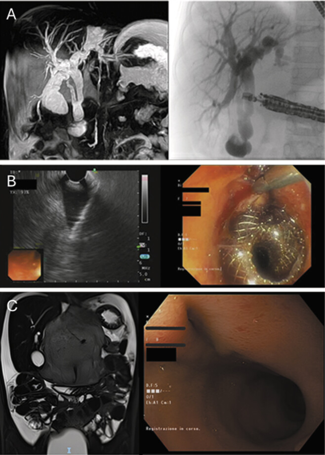 Endoscopic Cholecystoduodenostomy With Lumen-Apposing Metal Stent for Bile Duct Stricture in a Child with Neuroblastoma: A Case Report.