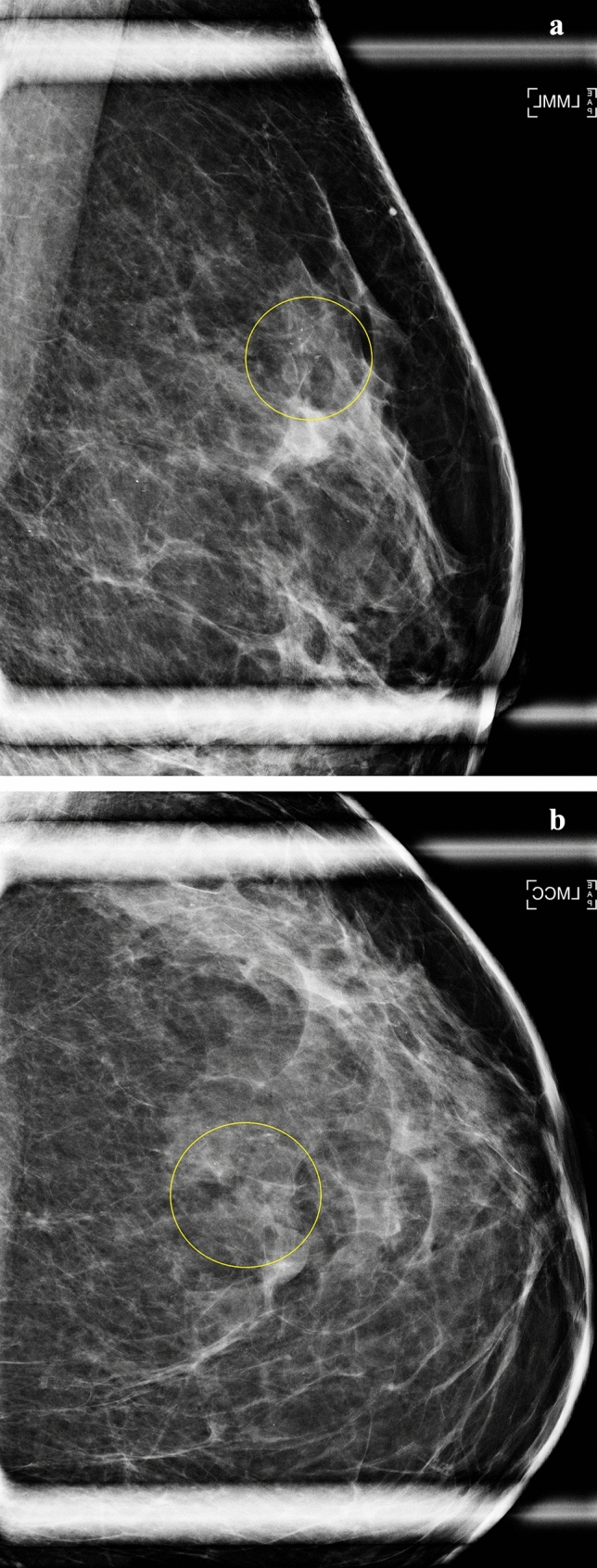 Mammographic calcifications association with risk of advanced breast cancer.