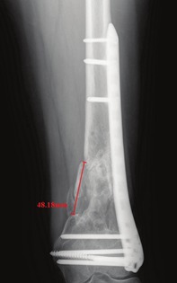 The Influence of Fracture Defect Size on Treatment Outcomes in Distal Femur Fractures: A Comparative Study Between Lateral Locking Plate and Double Plate Fixation.