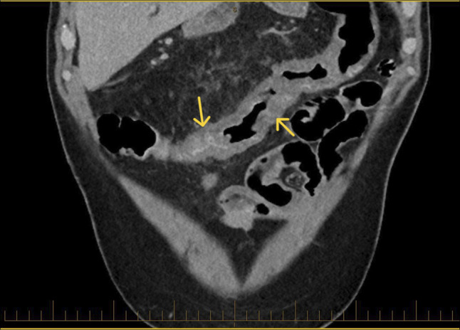 Management of Bleeding due to Idiopathic Colonic Varices.