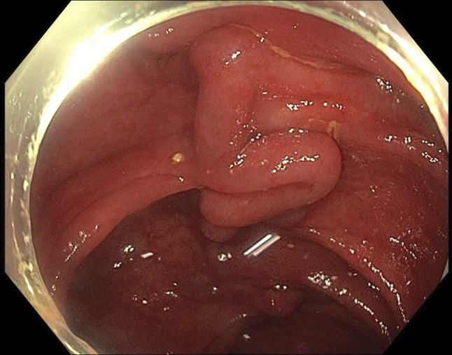 Management of Bleeding due to Idiopathic Colonic Varices.