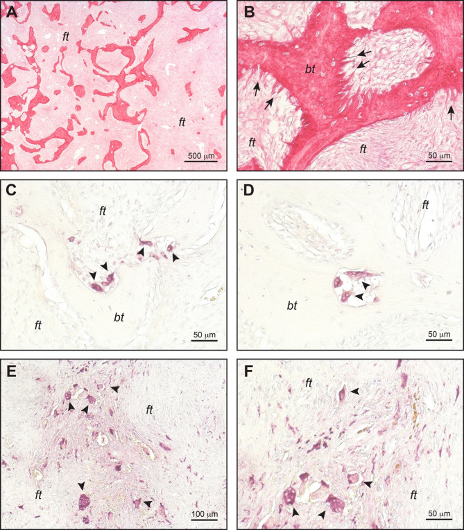 Fibrous dysplasia/McCune-Albright syndrome: state-of-the-art advances, pathogenesis, and basic/translational research.
