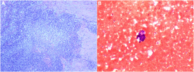 Spontaneous Rupture of a Low-Grade Endometrial Stromal Sarcoma: A Case Report and Review of Imaging.