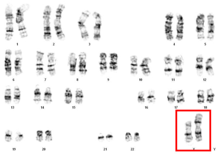 Bilateral Streak Ovaries in a Patient with Isochromosome Xq: A Case Report of a Turner Syndrome Variant.