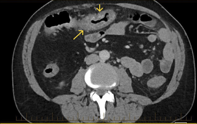 Management of Bleeding due to Idiopathic Colonic Varices.