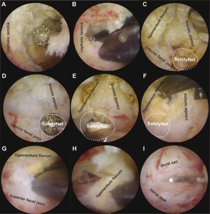 Unilateral Biportal Endoscopic Decompression for Degenerative Lumbar Spinal Stenosis Under Local Anesthesia in Elderly Patients with Medical Comorbidities.