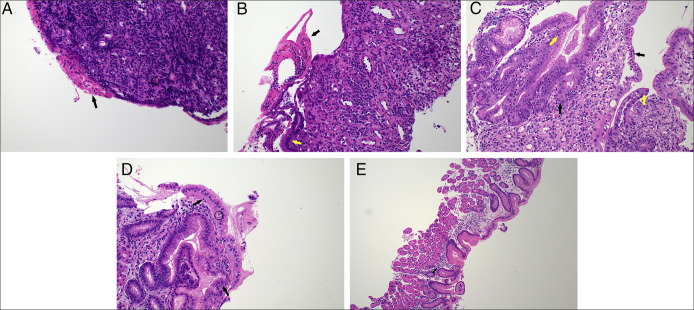Nivolumab-Induced Refractory Hemorrhagic Gastritis and Duodenitis Requiring Multimodal Biologic Therapy.
