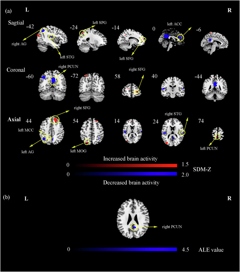 Structural and functional brain abnormal alteration in patients with type 2 diabetes mellitus: A coordinate-based meta-analysis.
