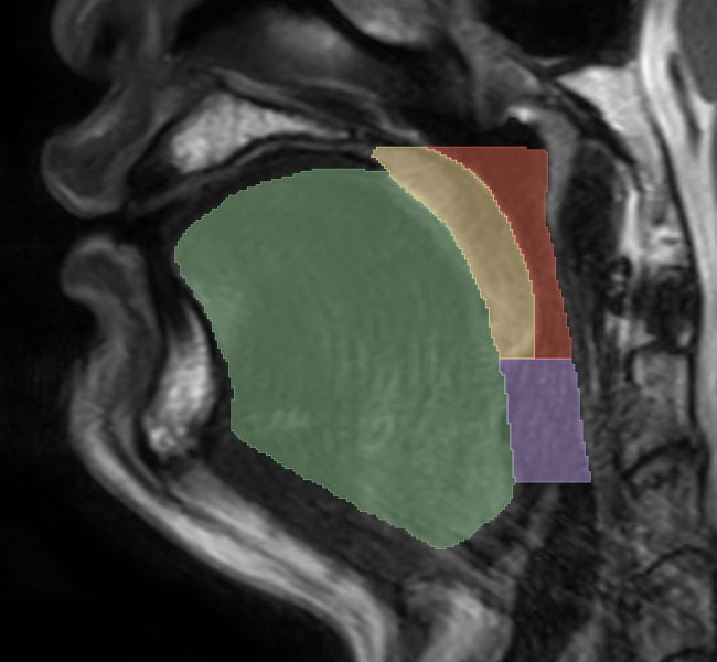 Predictive modeling of obstructive sleep apnea using pharyngeal magnetic resonance imaging radiomics and clinical data.