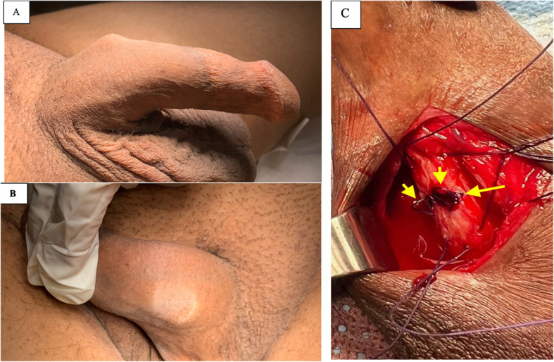 Management of tunica albuginea disruption secondary to malleable penile implant fracture: insights into etiology and surgical approach.