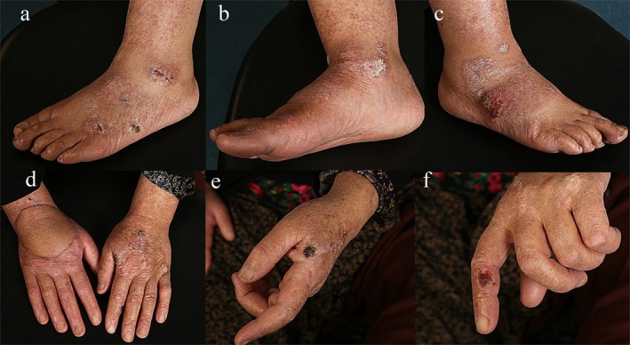 Multiple Skin Cancers Associated With Hydroxyurea: Case Report and Review of Literature.