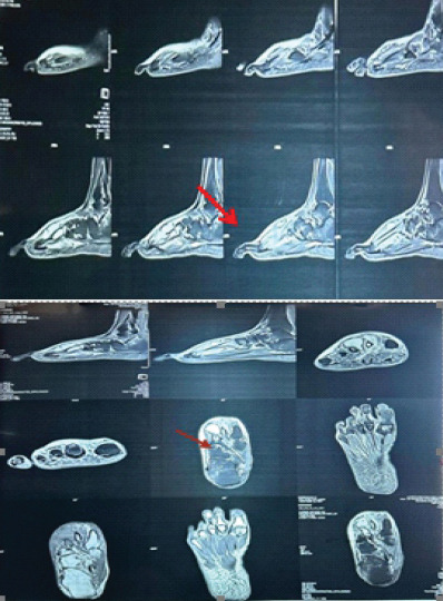 An Unusual Presentation of Keratinous Cyst - A Case Report.