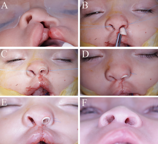 Assessment of symmetry and parental satisfaction after use of customized nasal conformers in unilateral cleft lip repair: a randomized controlled clinical trial.