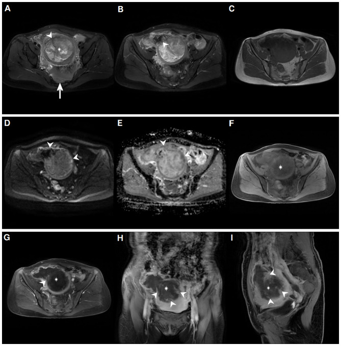 Spontaneous Rupture of a Low-Grade Endometrial Stromal Sarcoma: A Case Report and Review of Imaging.