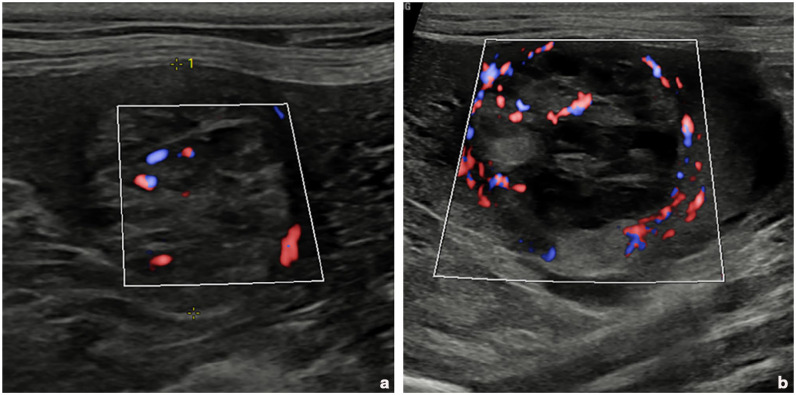 Splenic haemangiosarcoma in a cat treated with splenectomy and metronomic thalidomide.