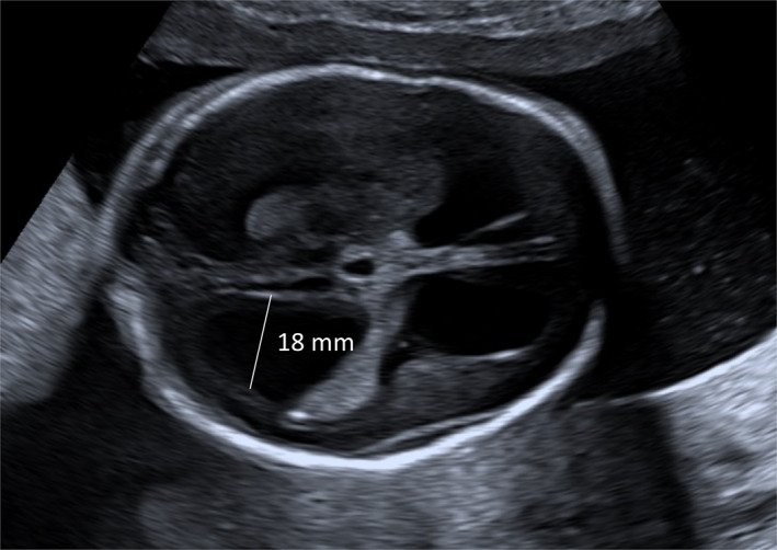 Clinical Outcome and Risk Factors for Progression of Prenatally Diagnosed Fetal Ventriculomegaly: A Retrospective Multicenter Study.