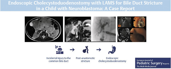 Endoscopic Cholecystoduodenostomy With Lumen-Apposing Metal Stent for Bile Duct Stricture in a Child with Neuroblastoma: A Case Report.