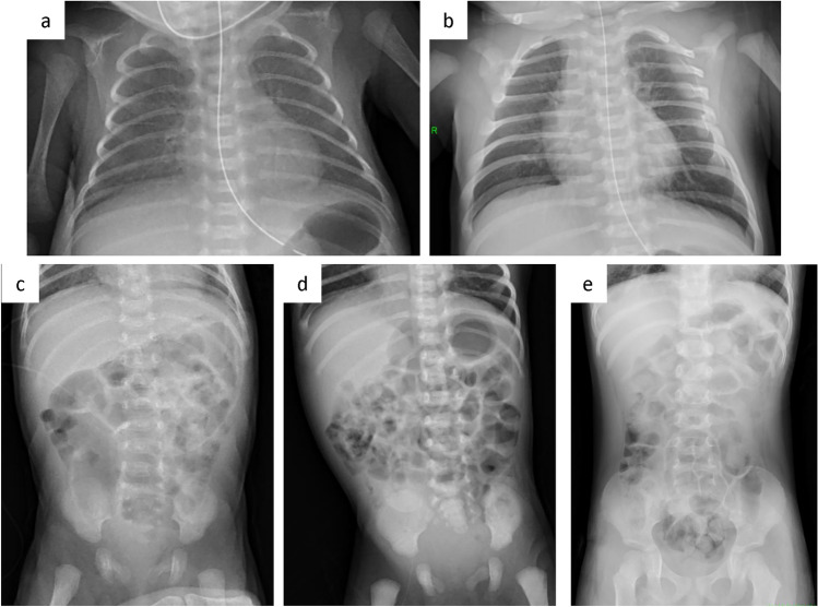 Improving image quality on pediatric and neonatal radiography using AI-based compensation for image degradation.