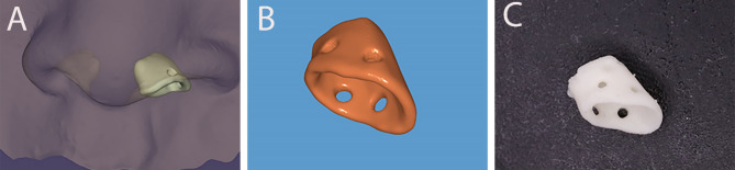 Assessment of symmetry and parental satisfaction after use of customized nasal conformers in unilateral cleft lip repair: a randomized controlled clinical trial.