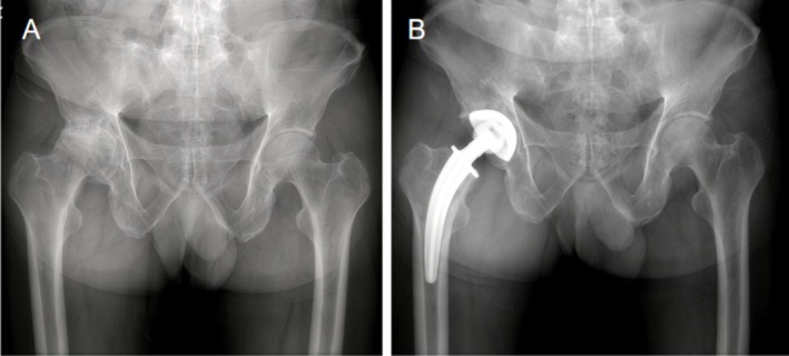 Is Collum Femoris Preserving Stem (CFP) an Epiphyseal-Stabilized Prosthesis? A Long-Term Single-Center Series Follow Up of 705 Cases.