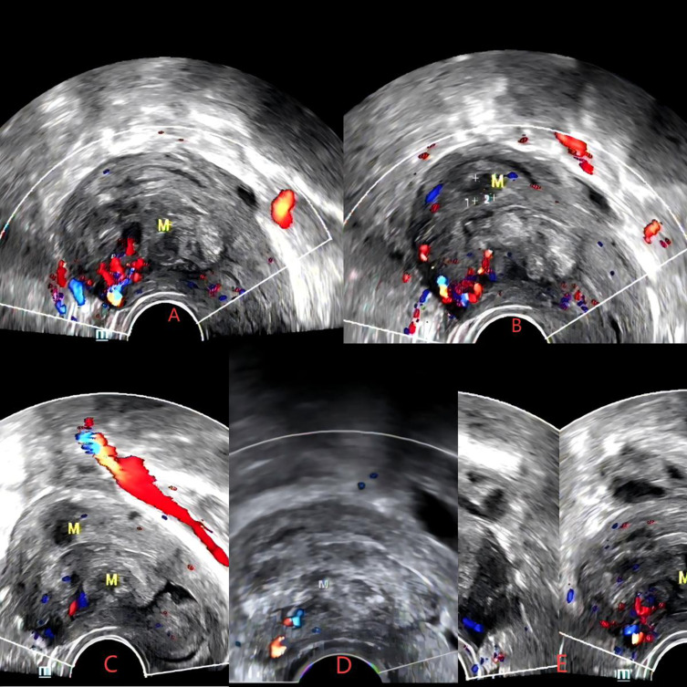 Hysteroscopic Myomectomy for Type 2 Submucosal Myoma Pretreated by HIFU and Mifepristone Treatment: A Case Report and Literature Review.