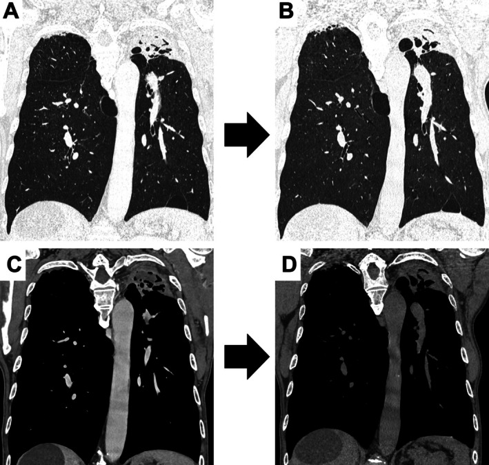 A Case of Bronchoscopic Removal of Aspergilloma in Patients With Non-Surgical Indications.